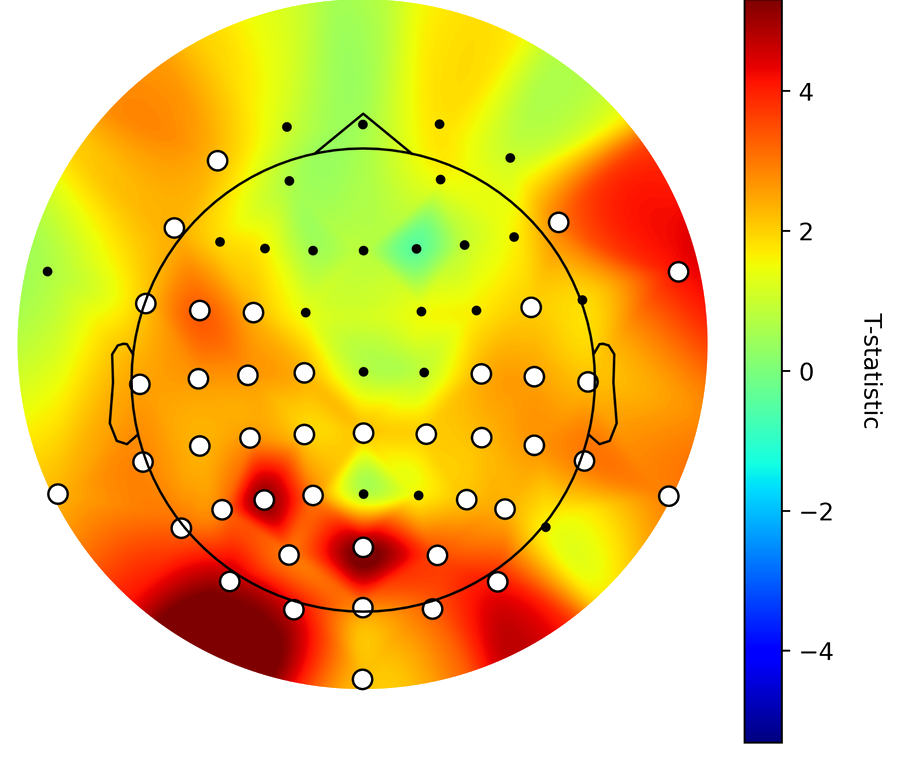 Scalp map of the increase in Lempel-Ziv complexity during chills